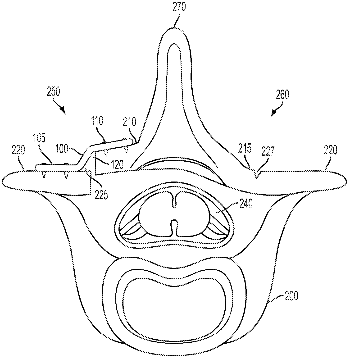 Laminoplasty system and method of use