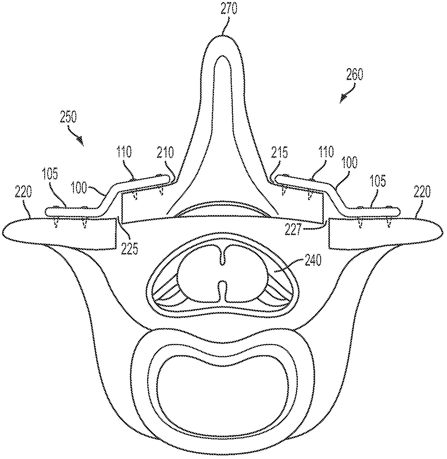 Laminoplasty system and method of use