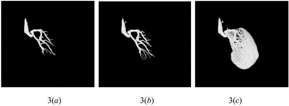 Partition method for kidney artery CT contrastographic picture vessels based on three-dimensional Zernike matrix