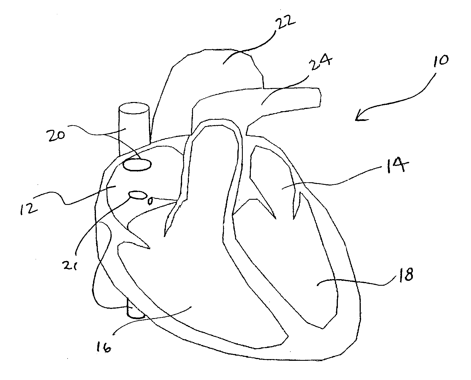 Cardiac pacing using the inferior nodal extension