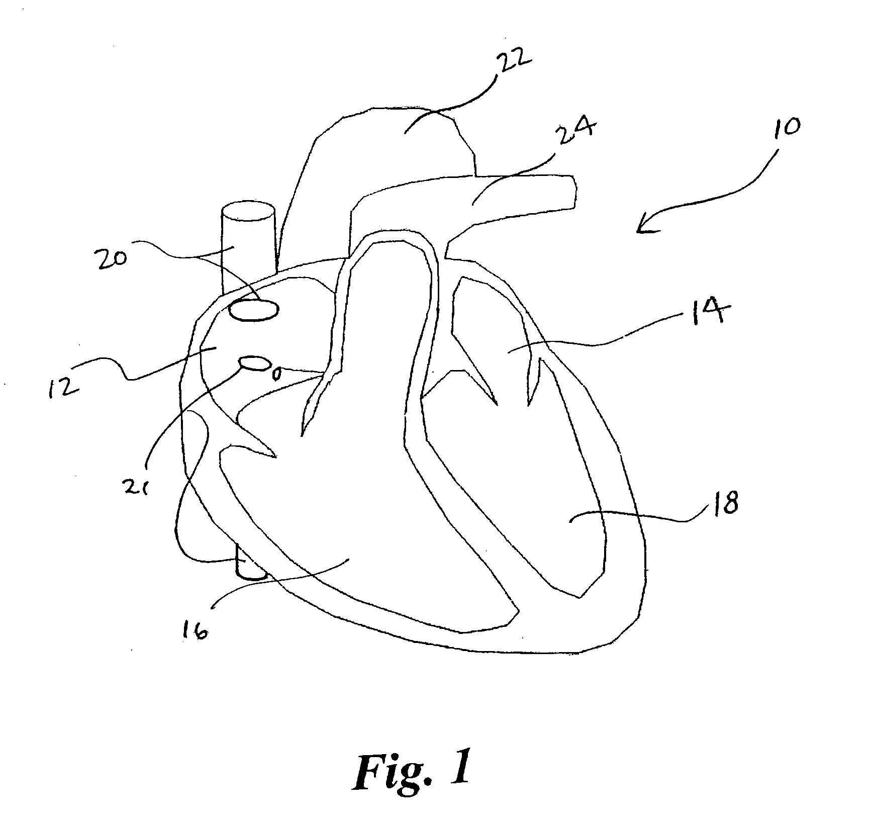 Cardiac pacing using the inferior nodal extension