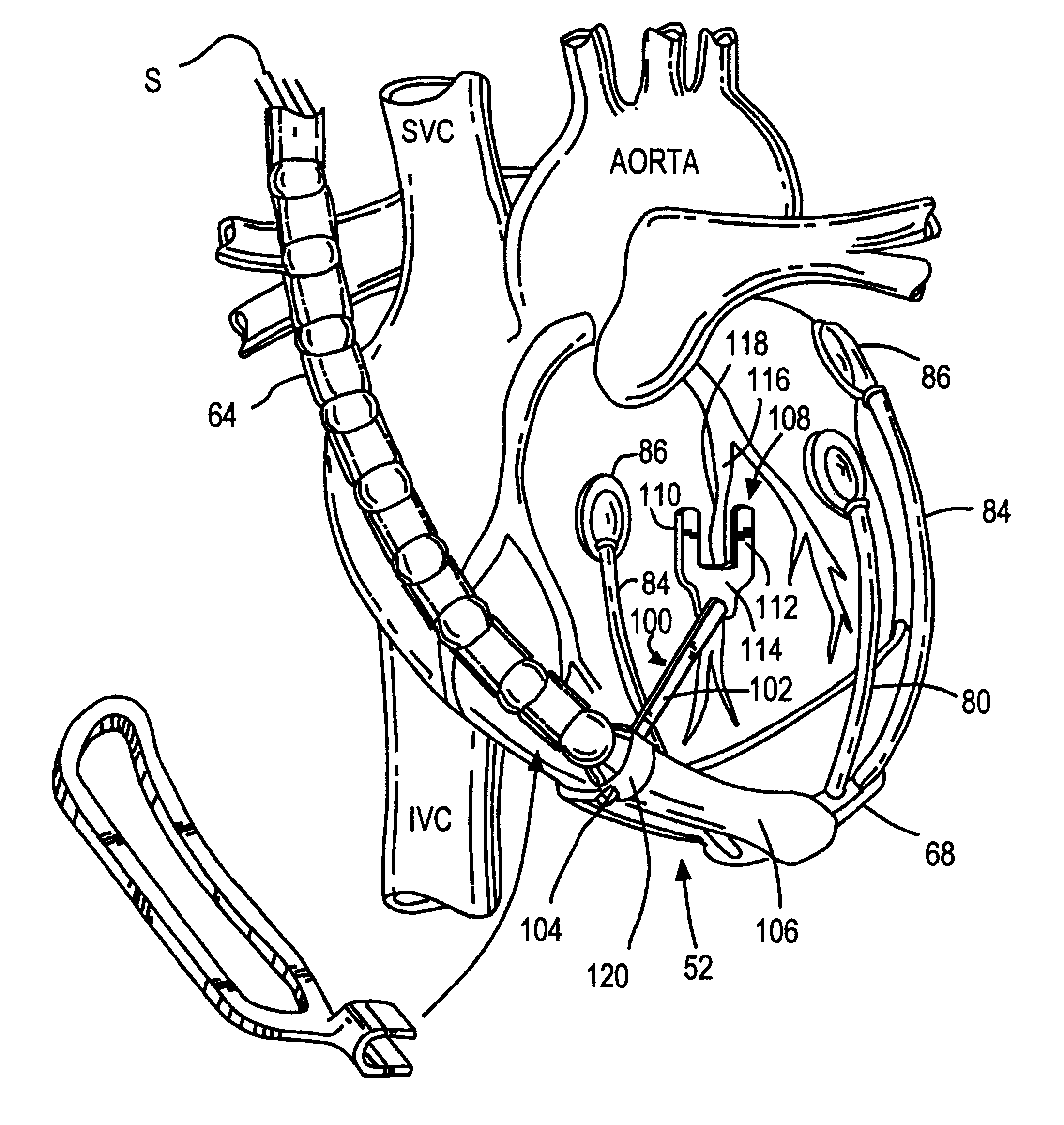 System to permit offpump beating heart coronary bypass surgery