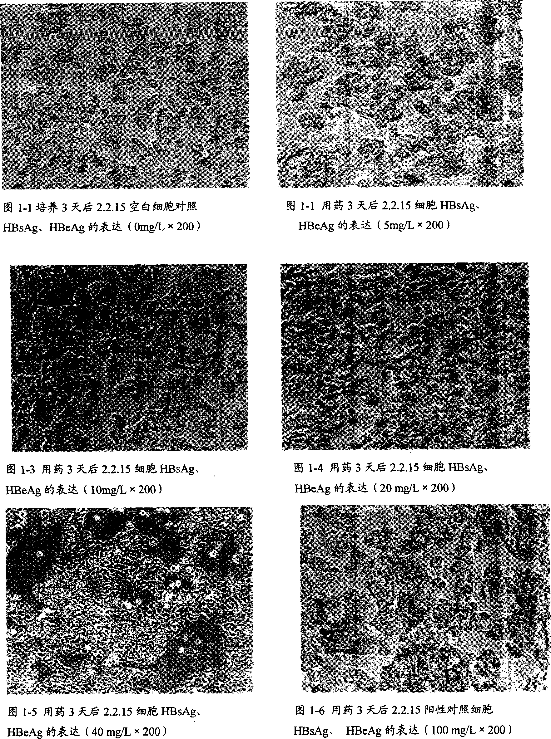 Technique for preparing liverwort extract and application of it in preparing medicine for treating liver cancer and hepatitis B