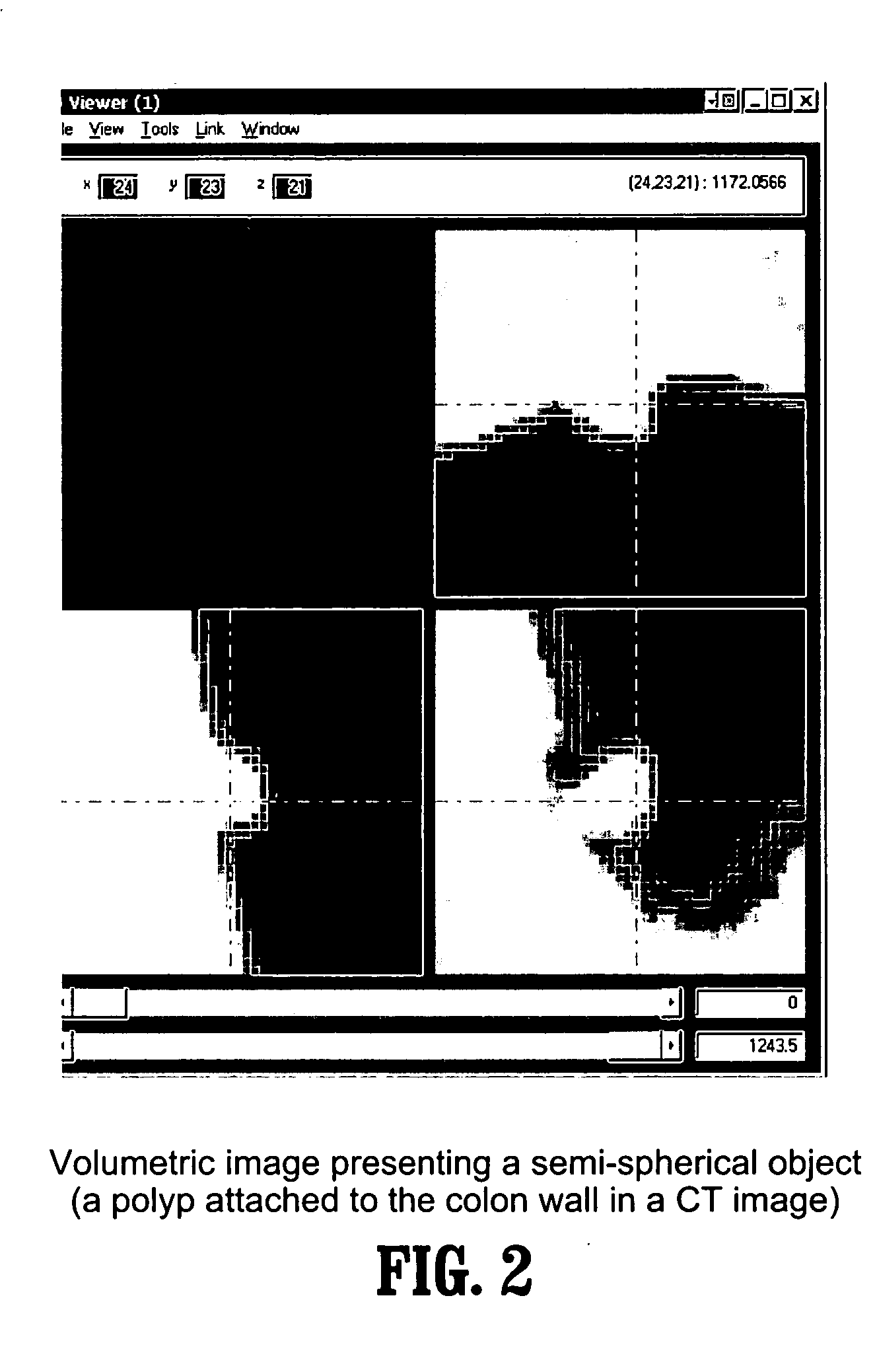 Method and system for fast normalized cross-correlation between an image and a gaussian for detecting spherical structures