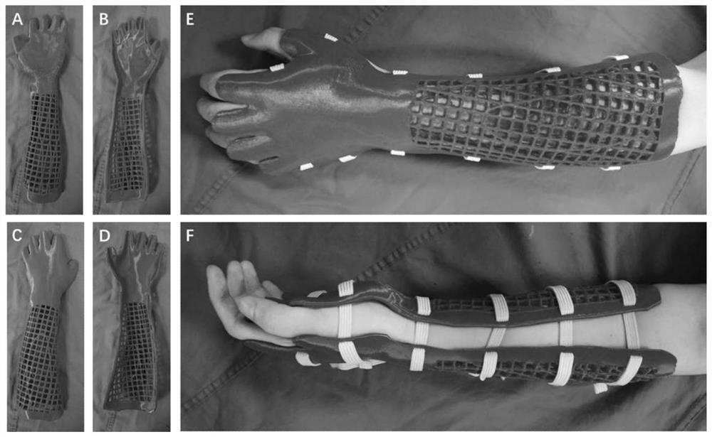 Manufacturing method of personalized protective brace for the forearm of children