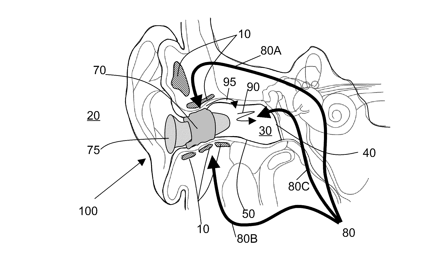 Occlusion effect mitigation and sound isolation device for orifice inserted systems