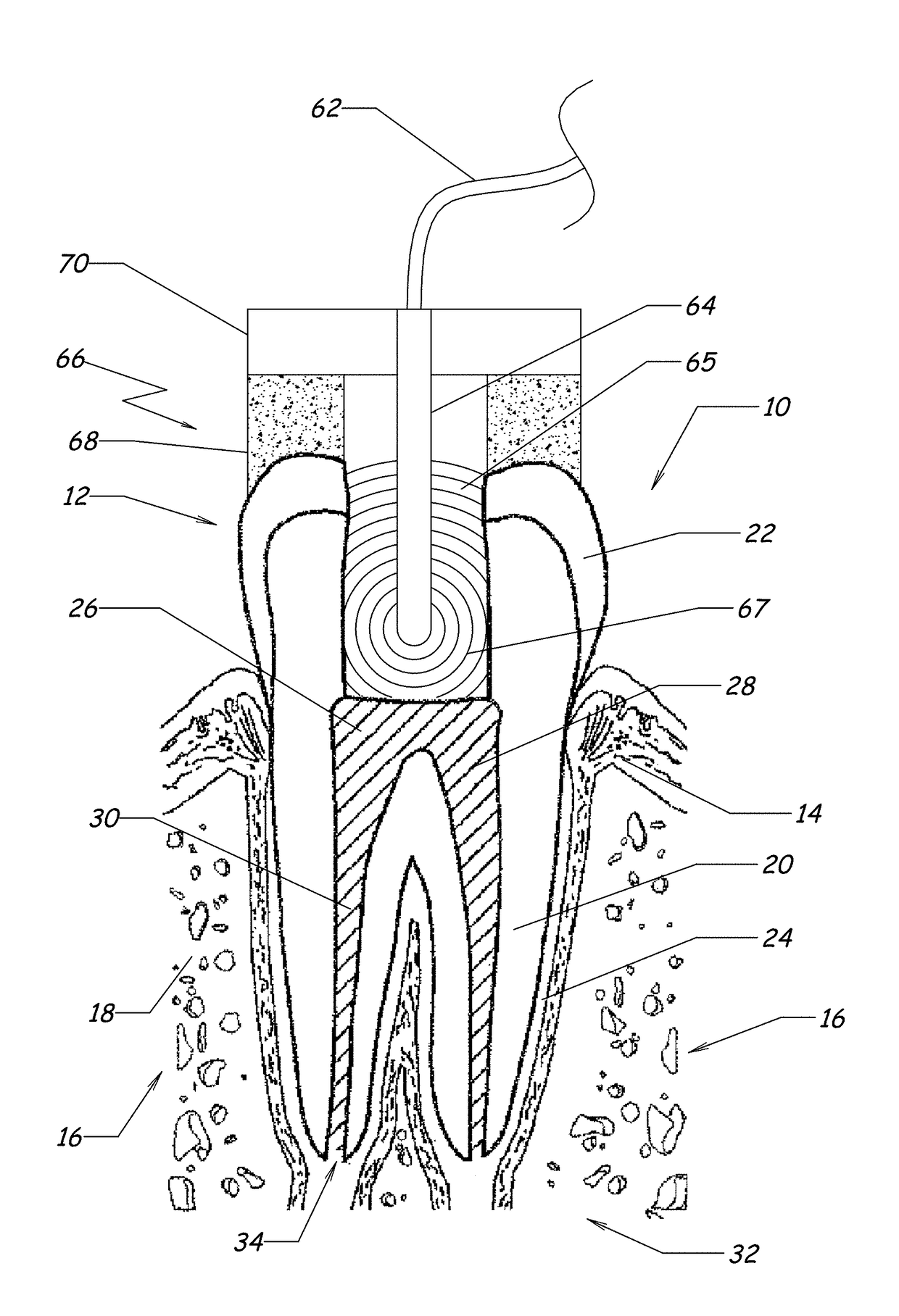 Apparatus, methods, and compositions for endodontic treatments