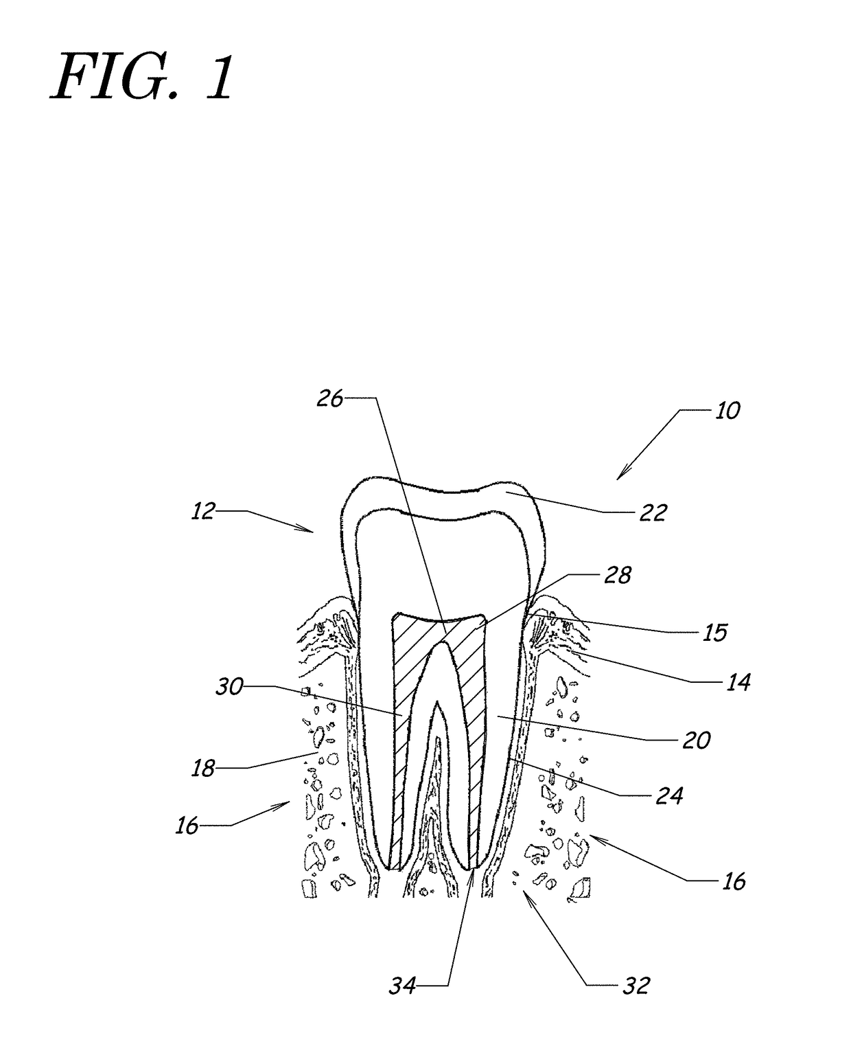 Apparatus, methods, and compositions for endodontic treatments