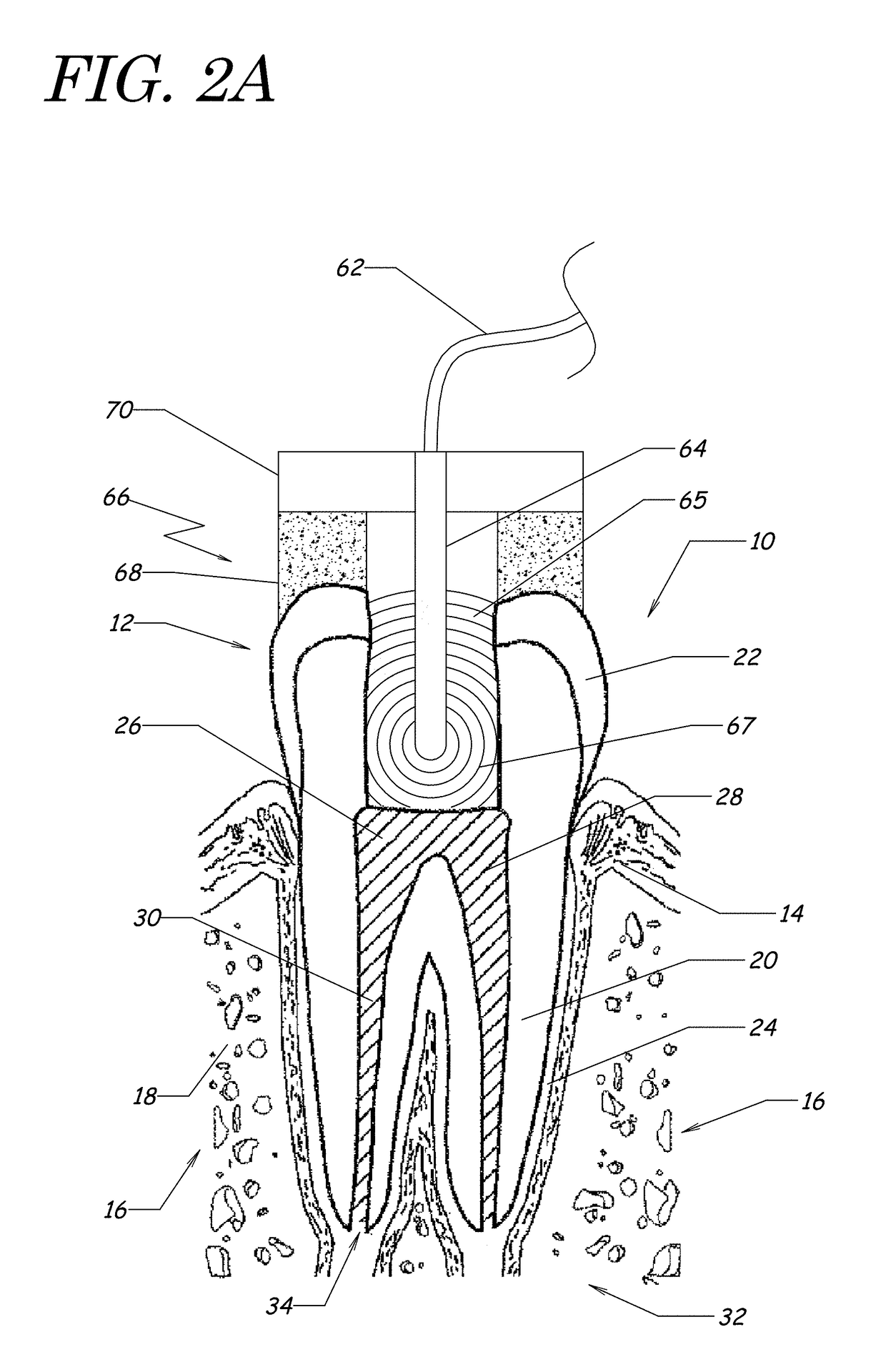 Apparatus, methods, and compositions for endodontic treatments