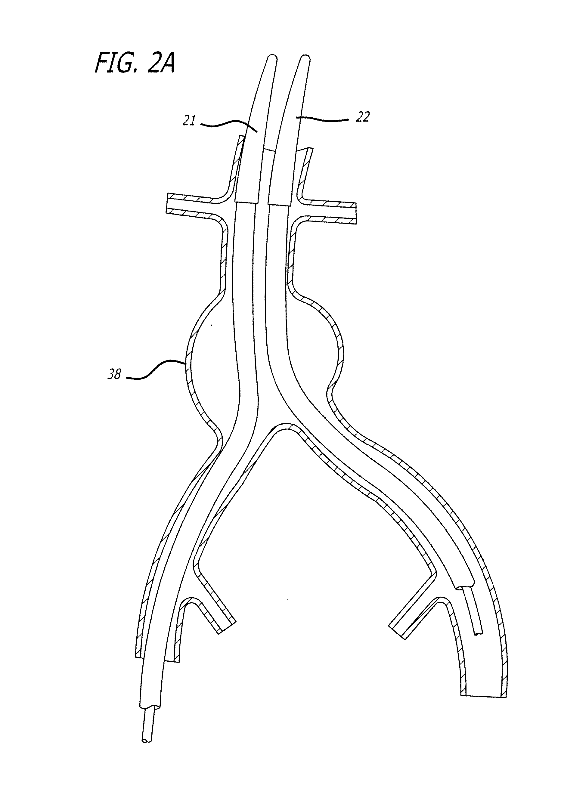 Low-profile modular abdominal aortic aneurysm graft