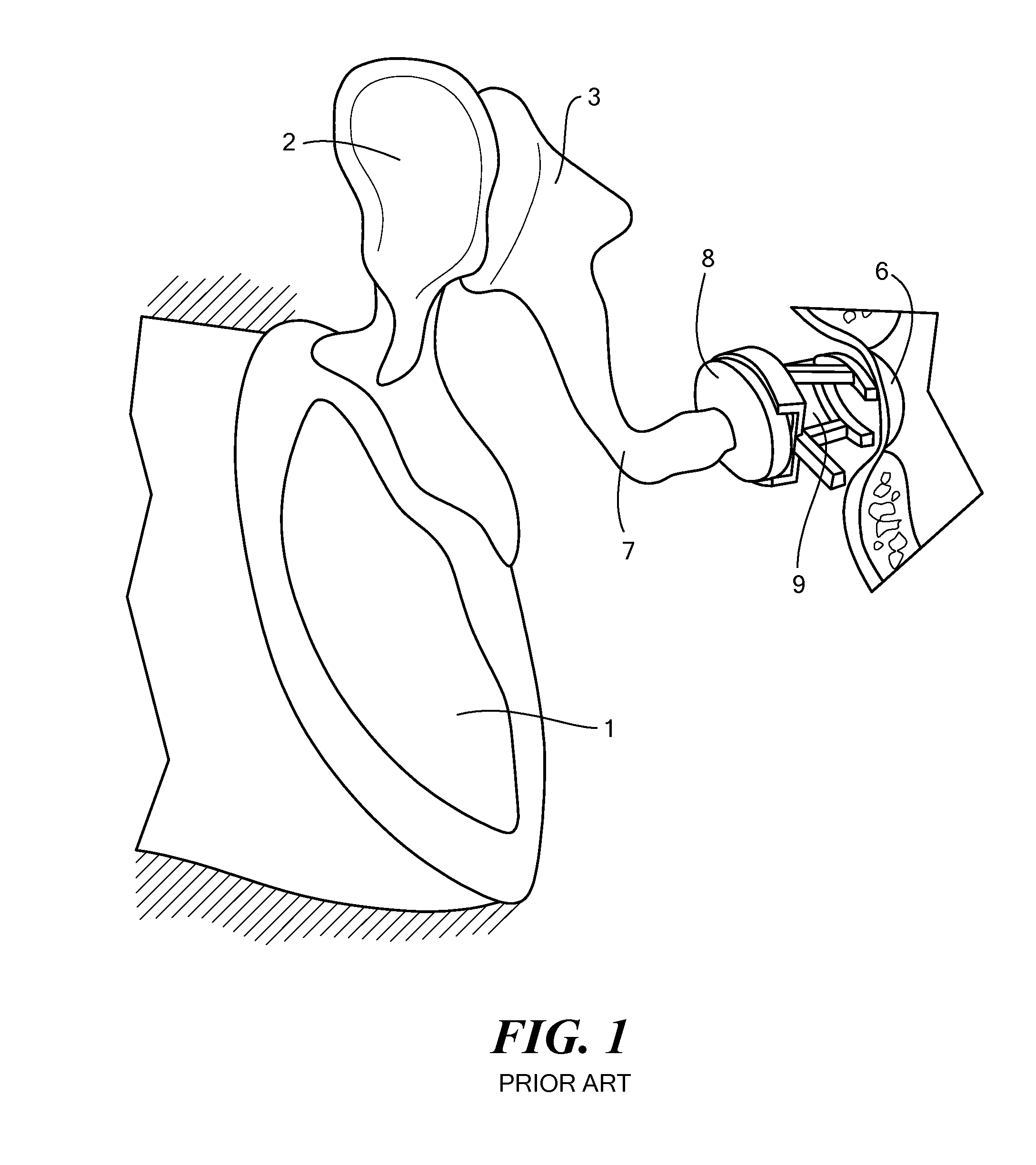 Implantable microphone for hearing systems