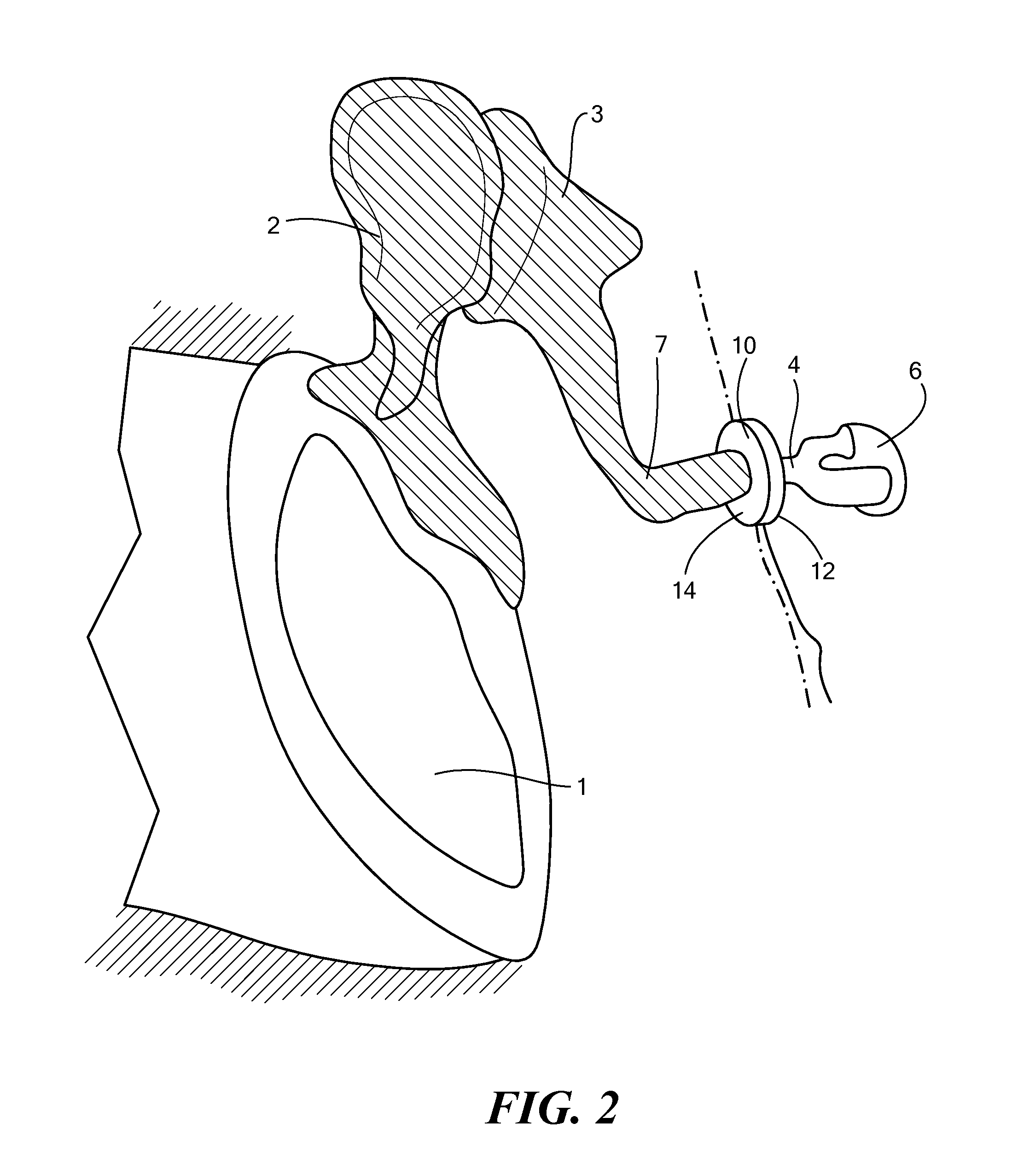 Implantable microphone for hearing systems