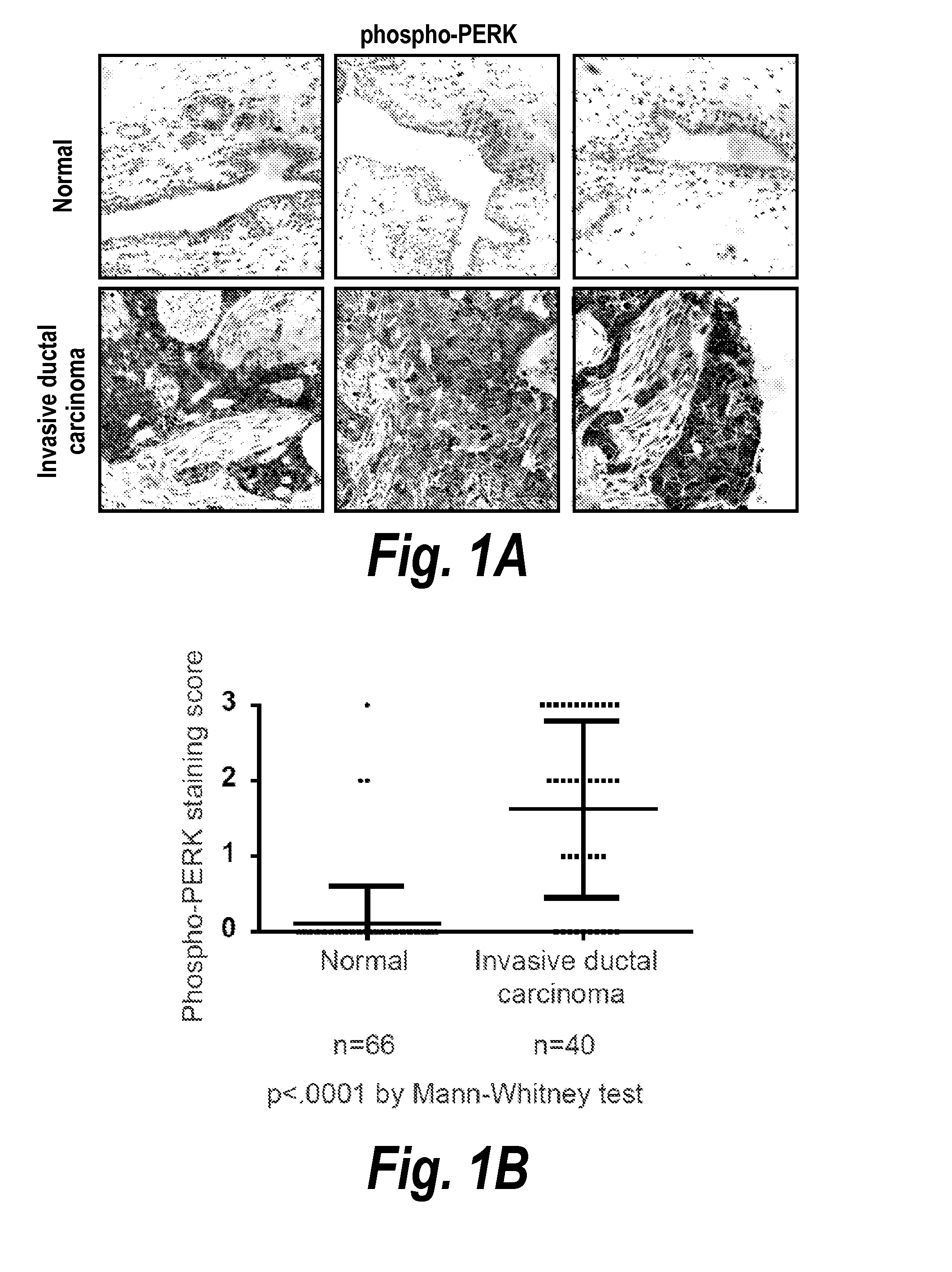 Modulation of breast cancer growth by modulation of xbp1 activity