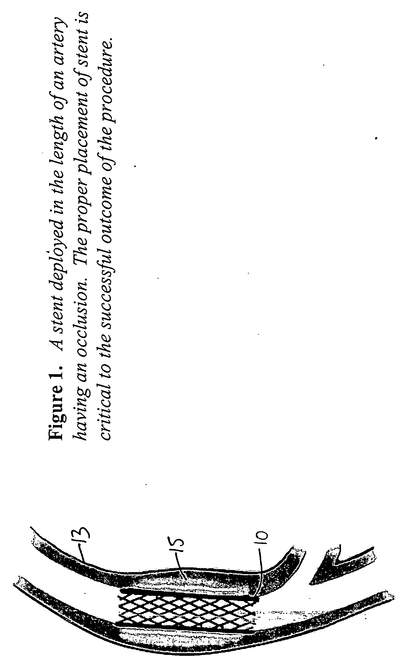 Multi-layered radiopaque coating on intravascular devices