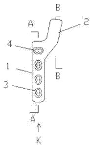 Blade plate for posterolateral fractures of tibial plateau