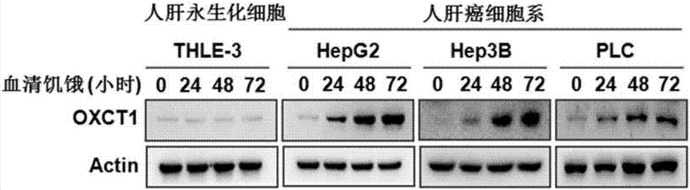 Hepatoma marker OXCT1 and application thereof to hepatoma diagnosis, treatment and prognosis