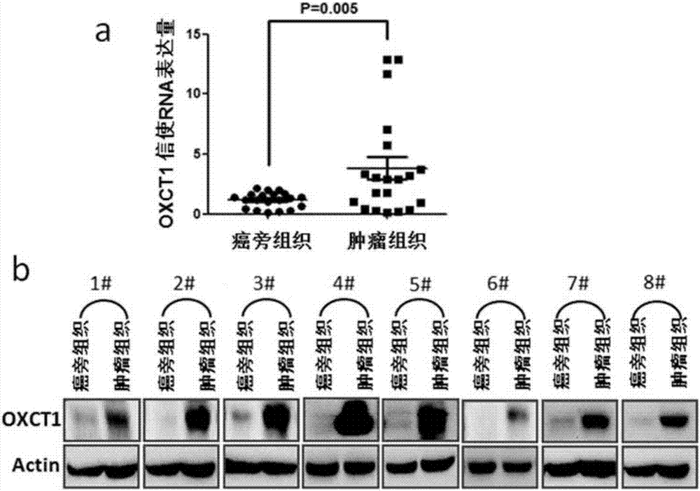 Hepatoma marker OXCT1 and application thereof to hepatoma diagnosis, treatment and prognosis