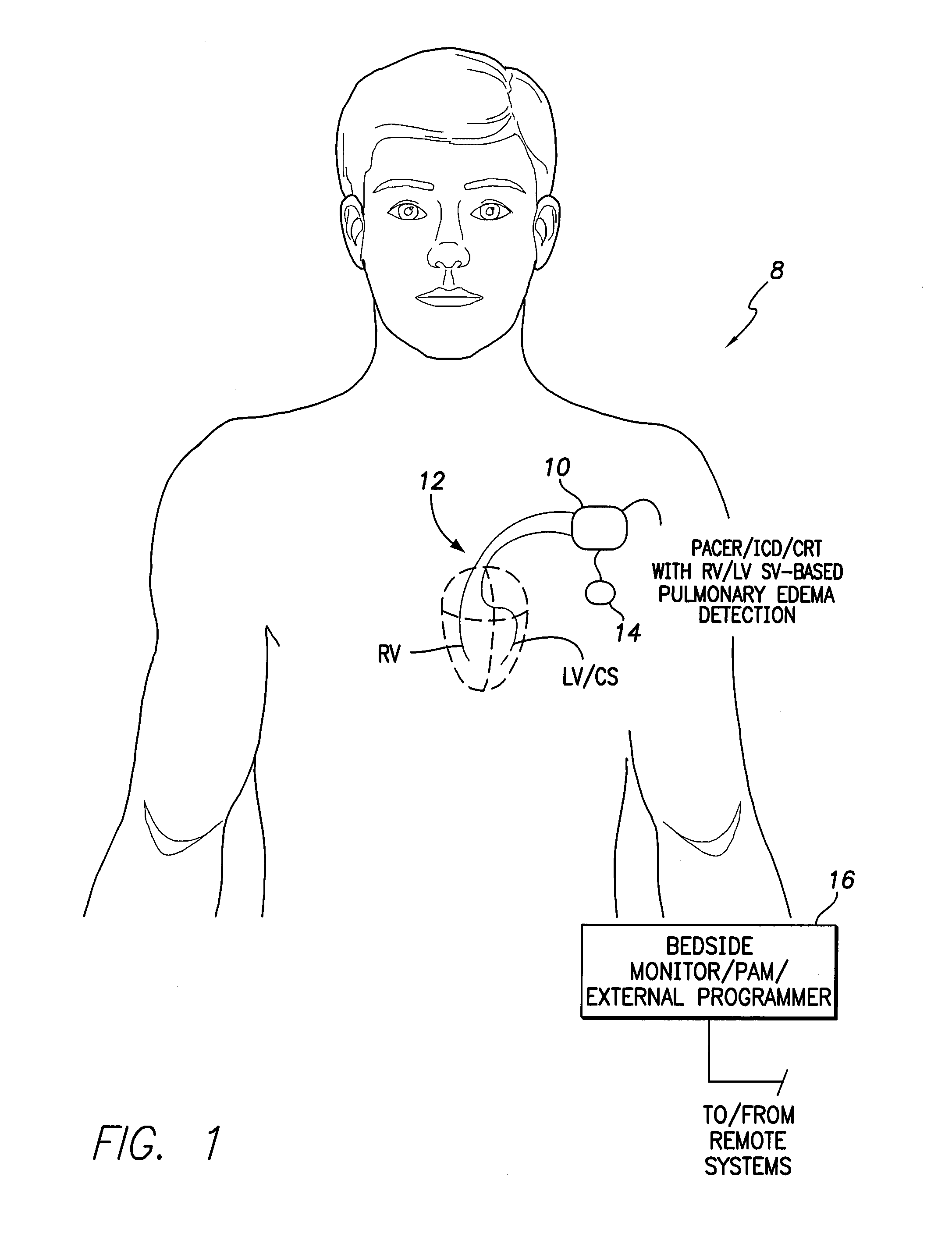 System and method for detecting pulmonary congestion based on stroke volume using an implantable medical device