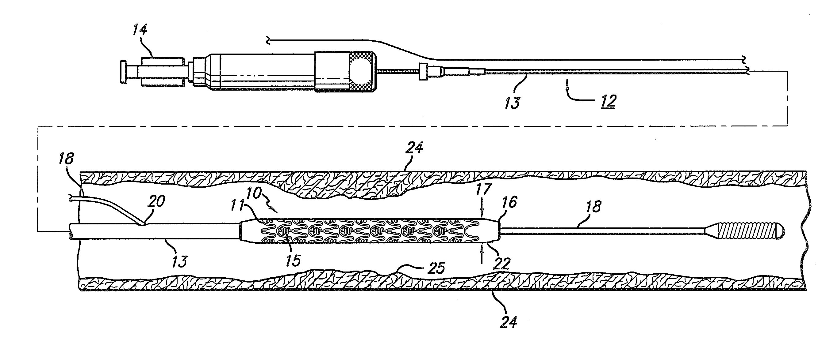 Stent assembly for the treatment of vulnerable plaque