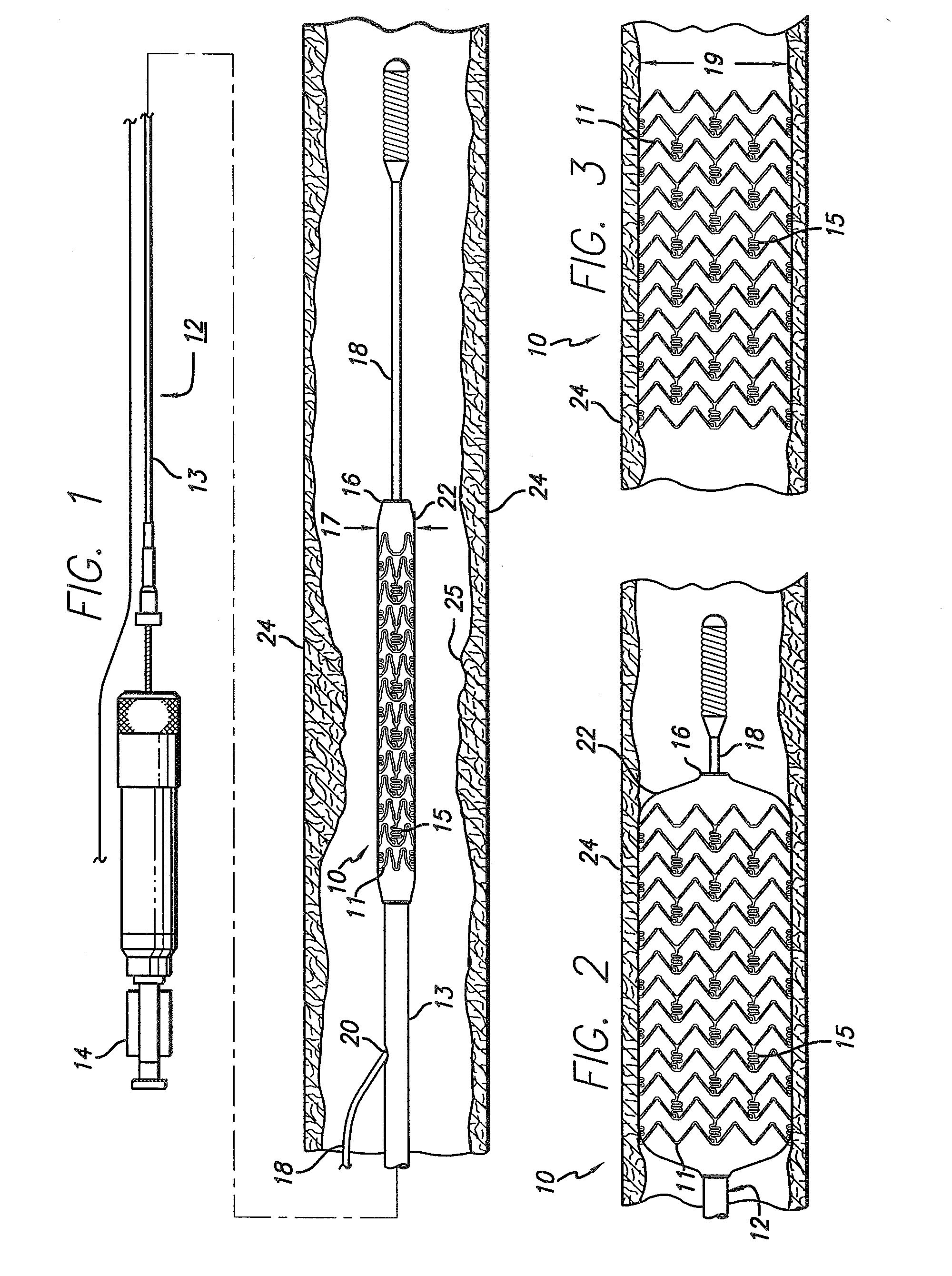 Stent assembly for the treatment of vulnerable plaque