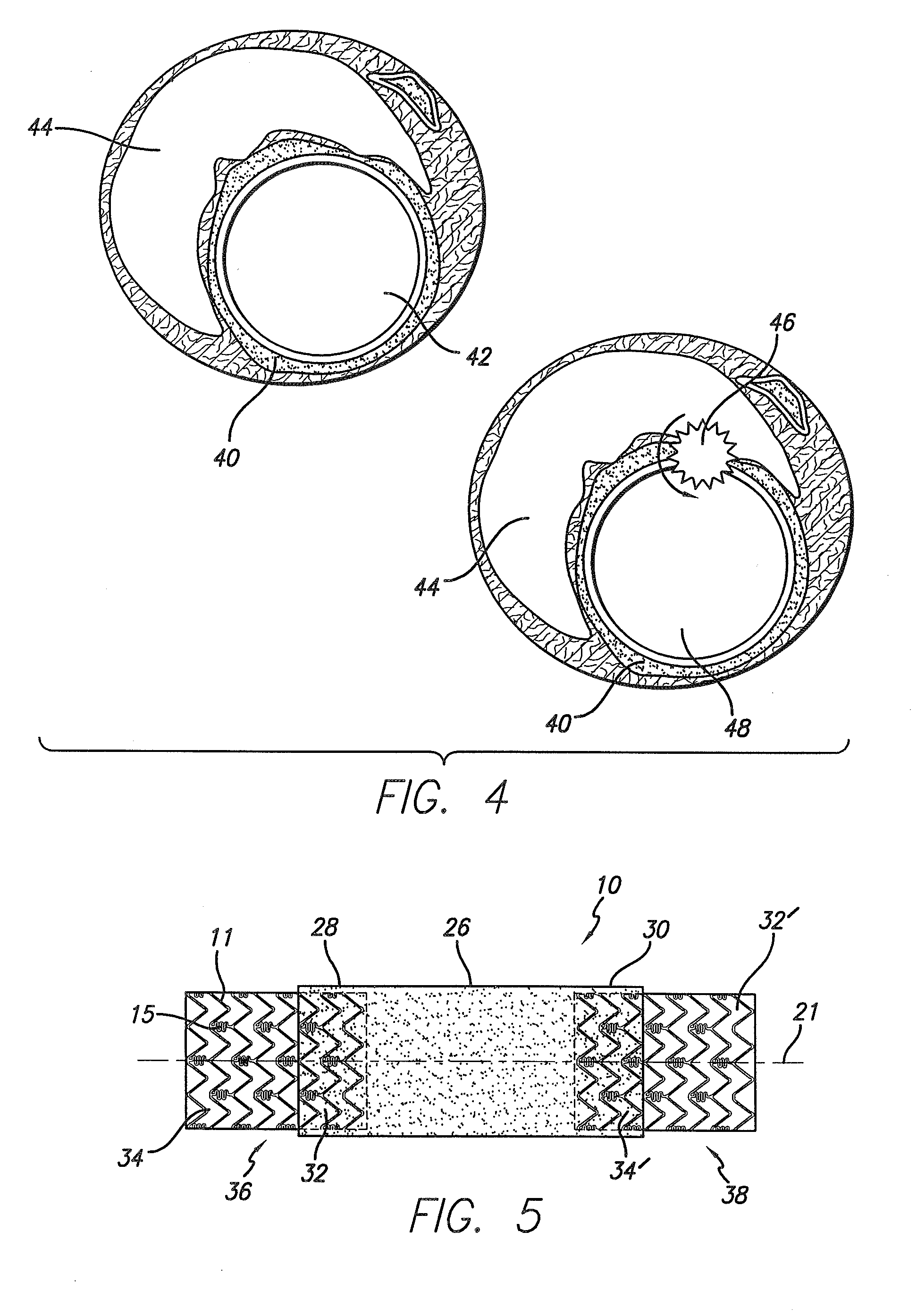 Stent assembly for the treatment of vulnerable plaque