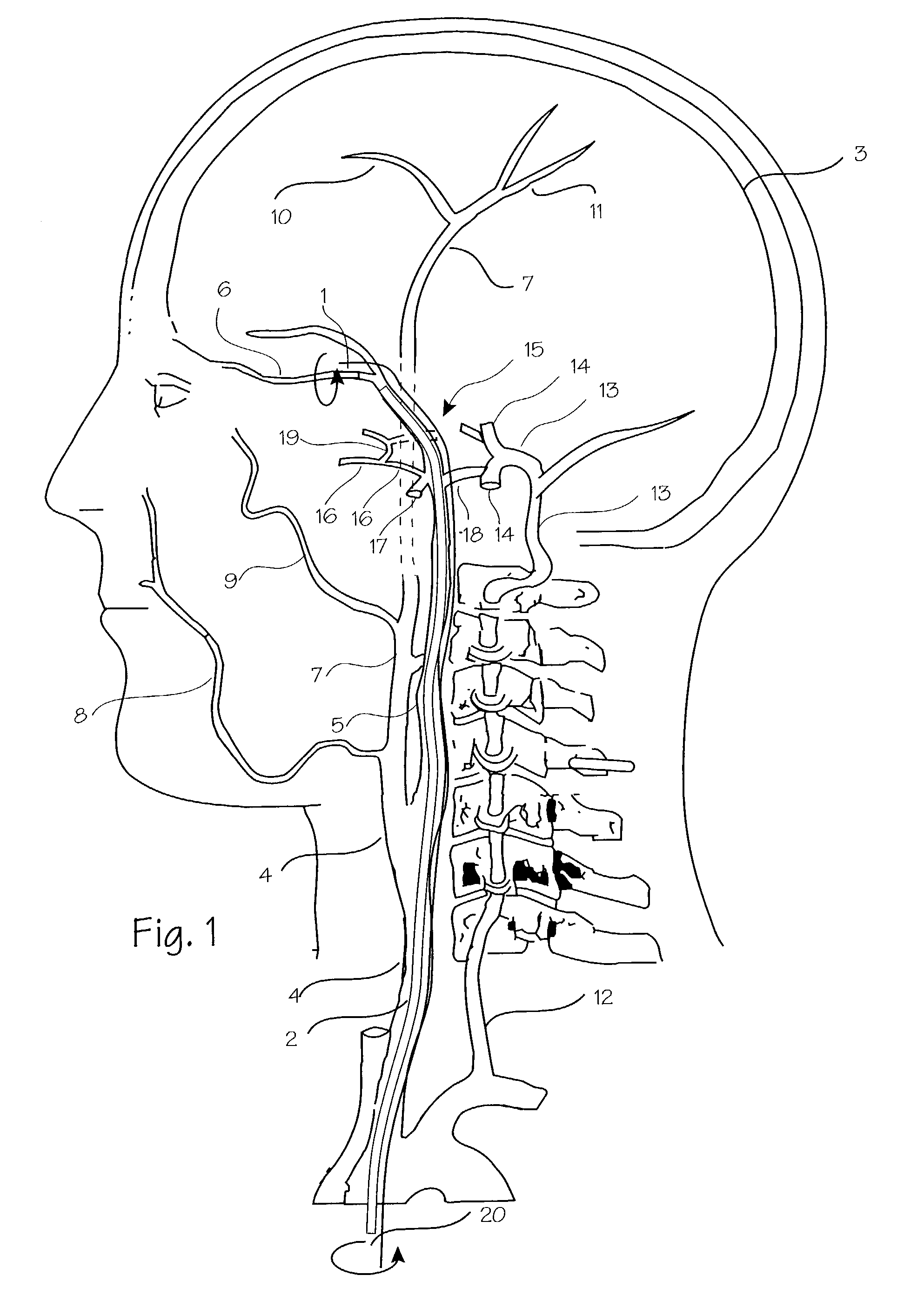 Expandable stent apparatus and method