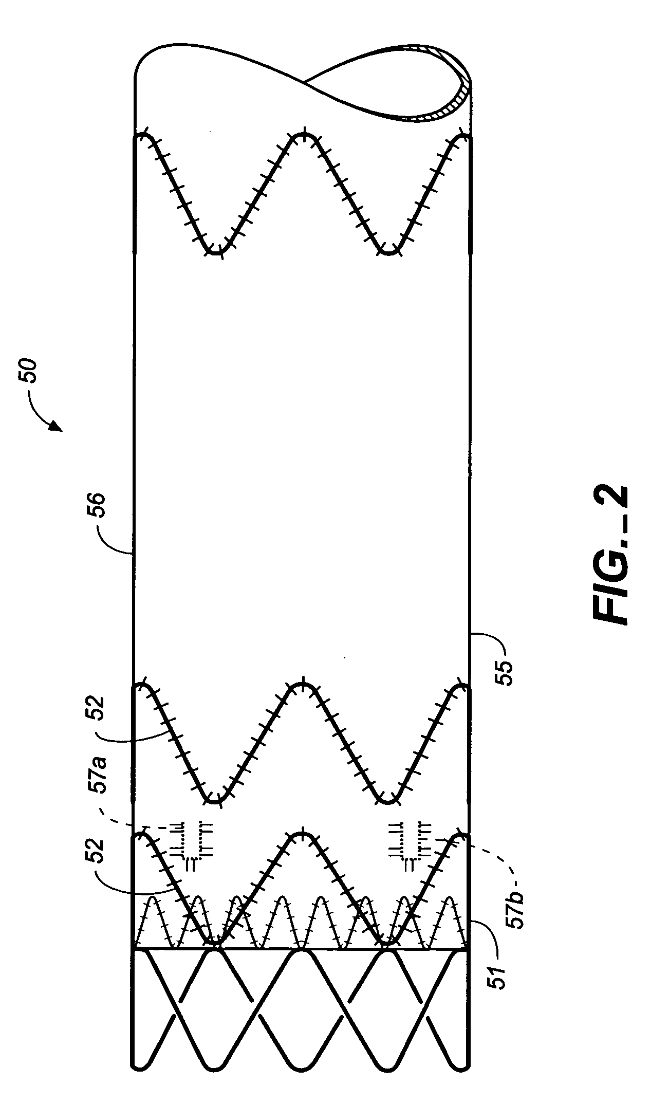 Device and method for delivering an endovascular stent-graft having a longitudinally unsupported portion