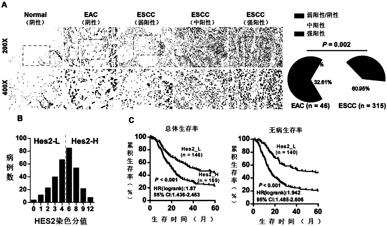 Application of gene HES2 to auxiliary diagnosis, prognosis and treatment of esophageal squamous carcinoma