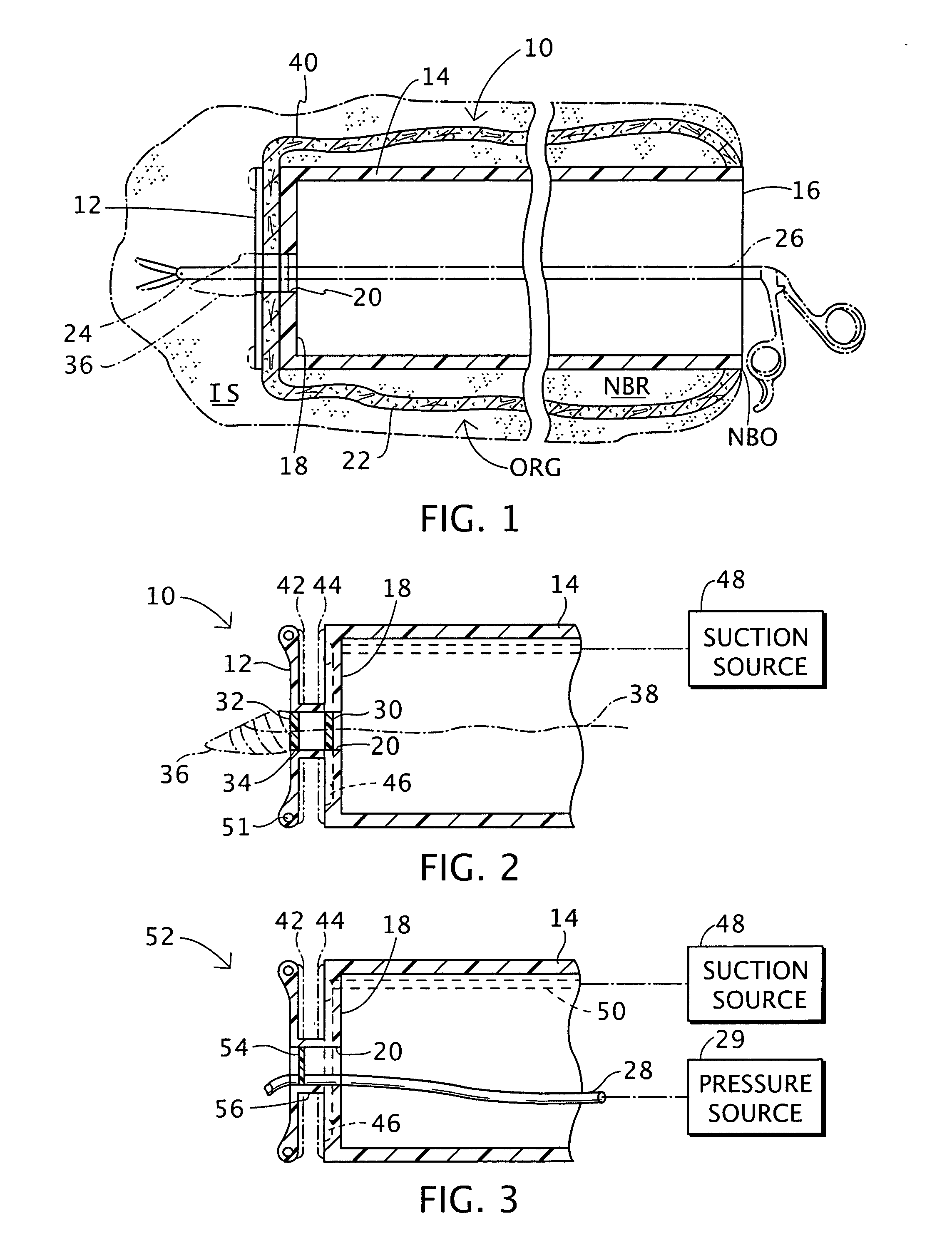 Surgical device and associated trans-organ surgical method