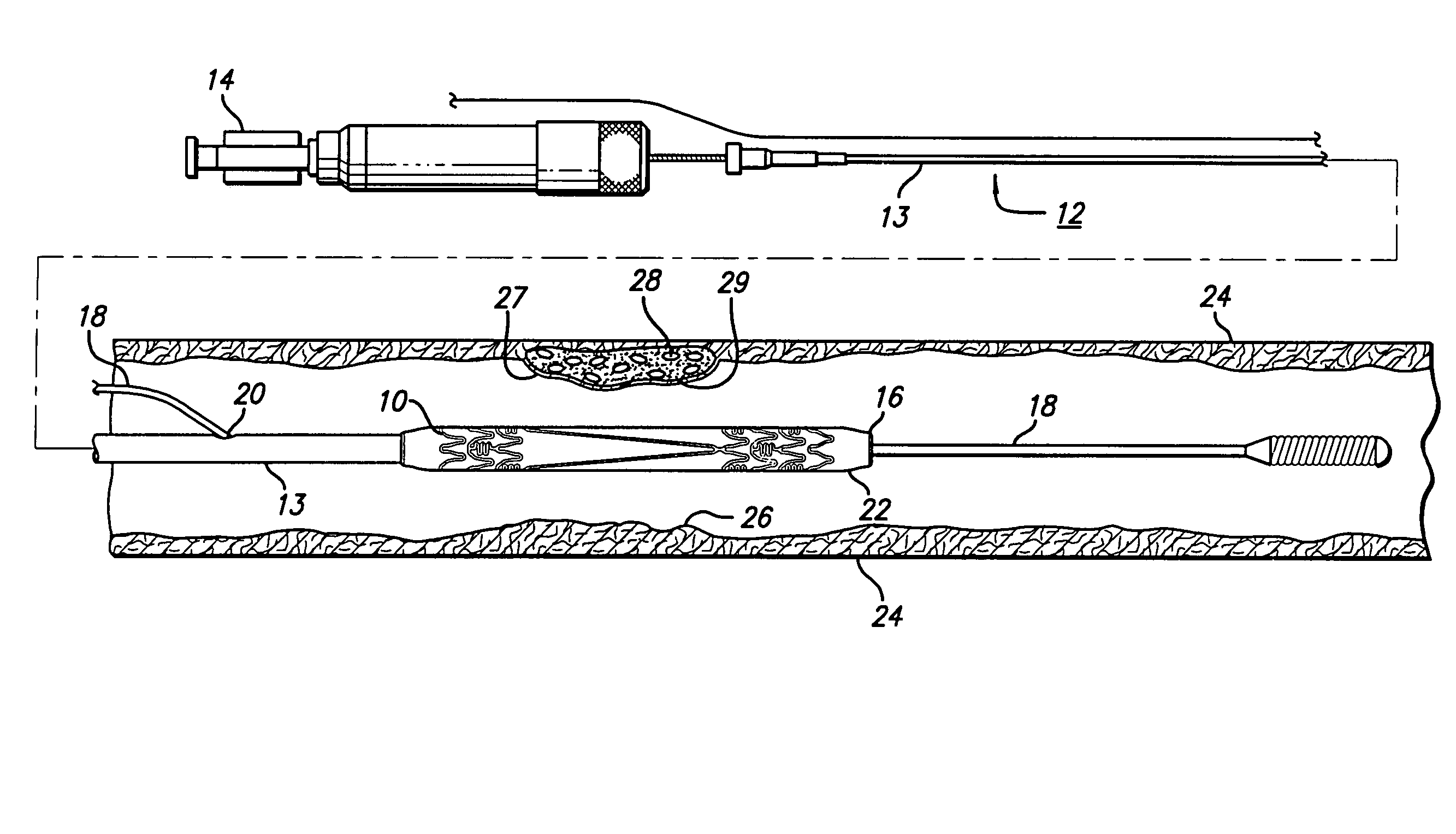 Intravascular stent and method of use