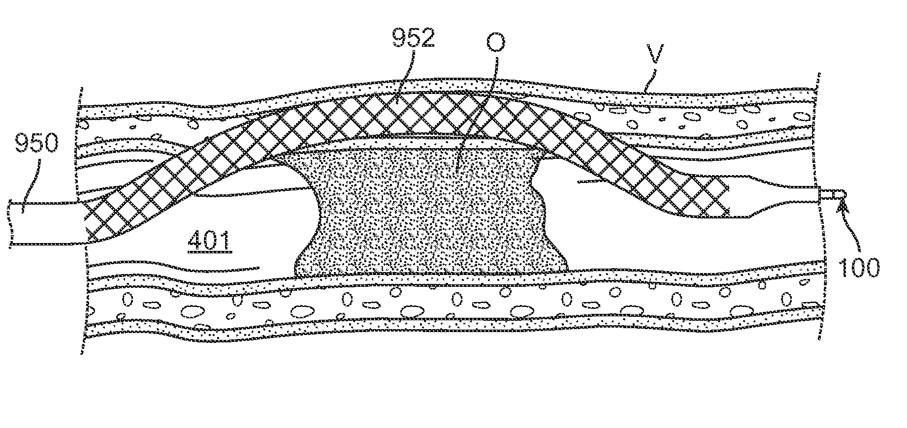 Methods and Systems for Bypassing an Occlusion in a Blood Vessel