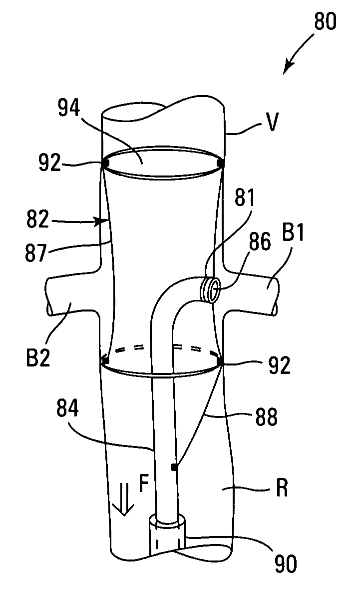 Embolic protection systems