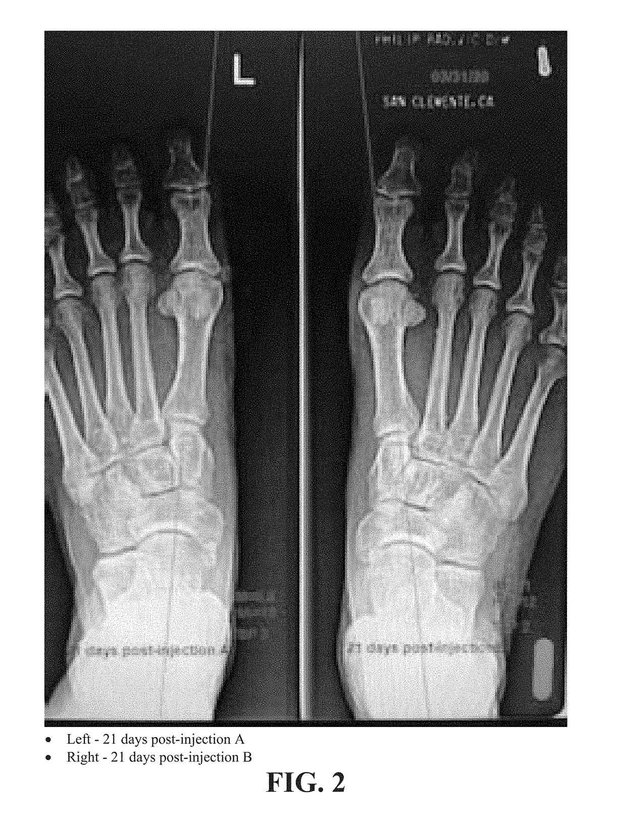 Methods of treating abnormalities of the first metatarsophalangeal joint of the foot