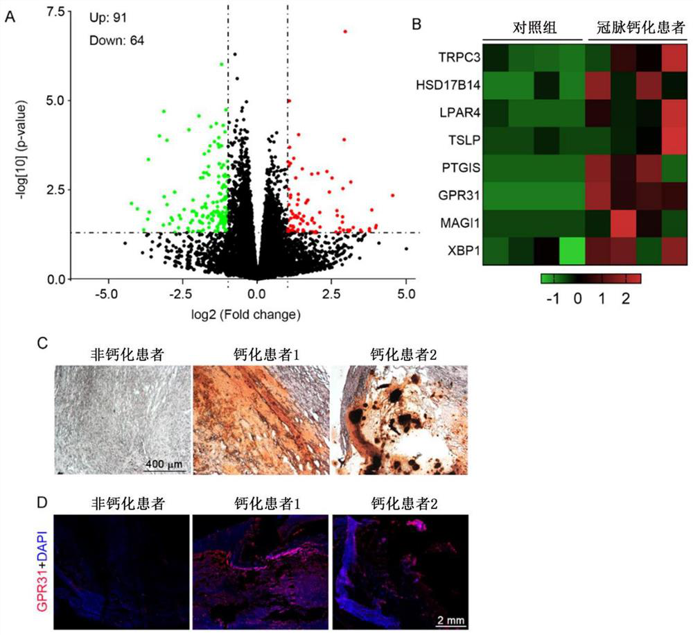 Application of GPR31 inhibitor in preparation of medicine for preventing and treating vascular calcification