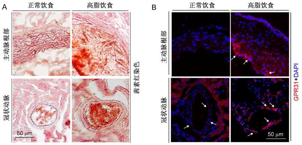 Application of GPR31 inhibitor in preparation of medicine for preventing and treating vascular calcification