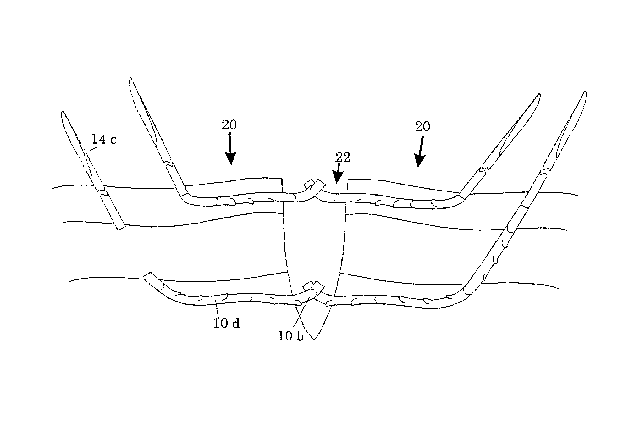 Surgical methods using one-way suture