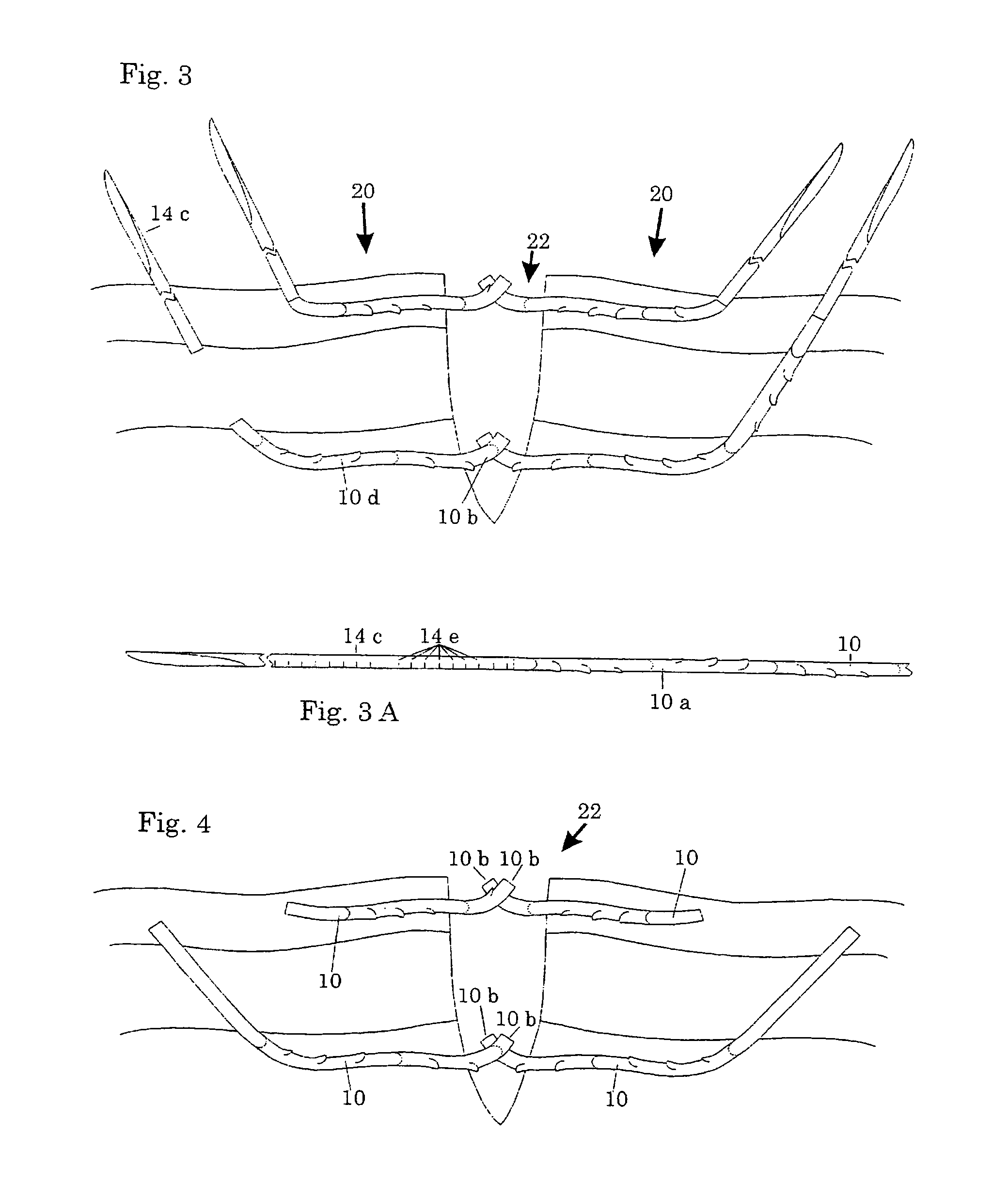 Surgical methods using one-way suture