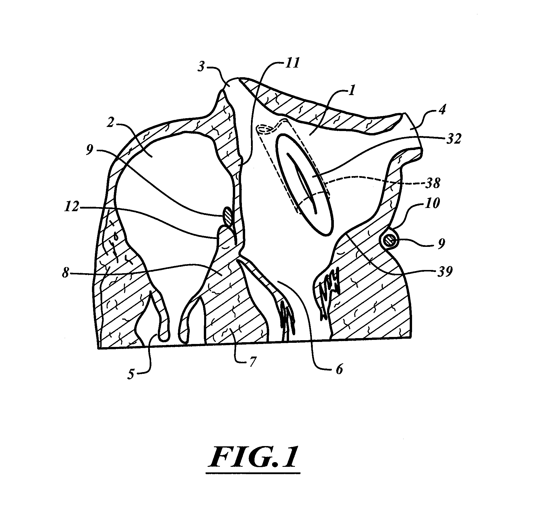 Method for anchoring a mitral valve