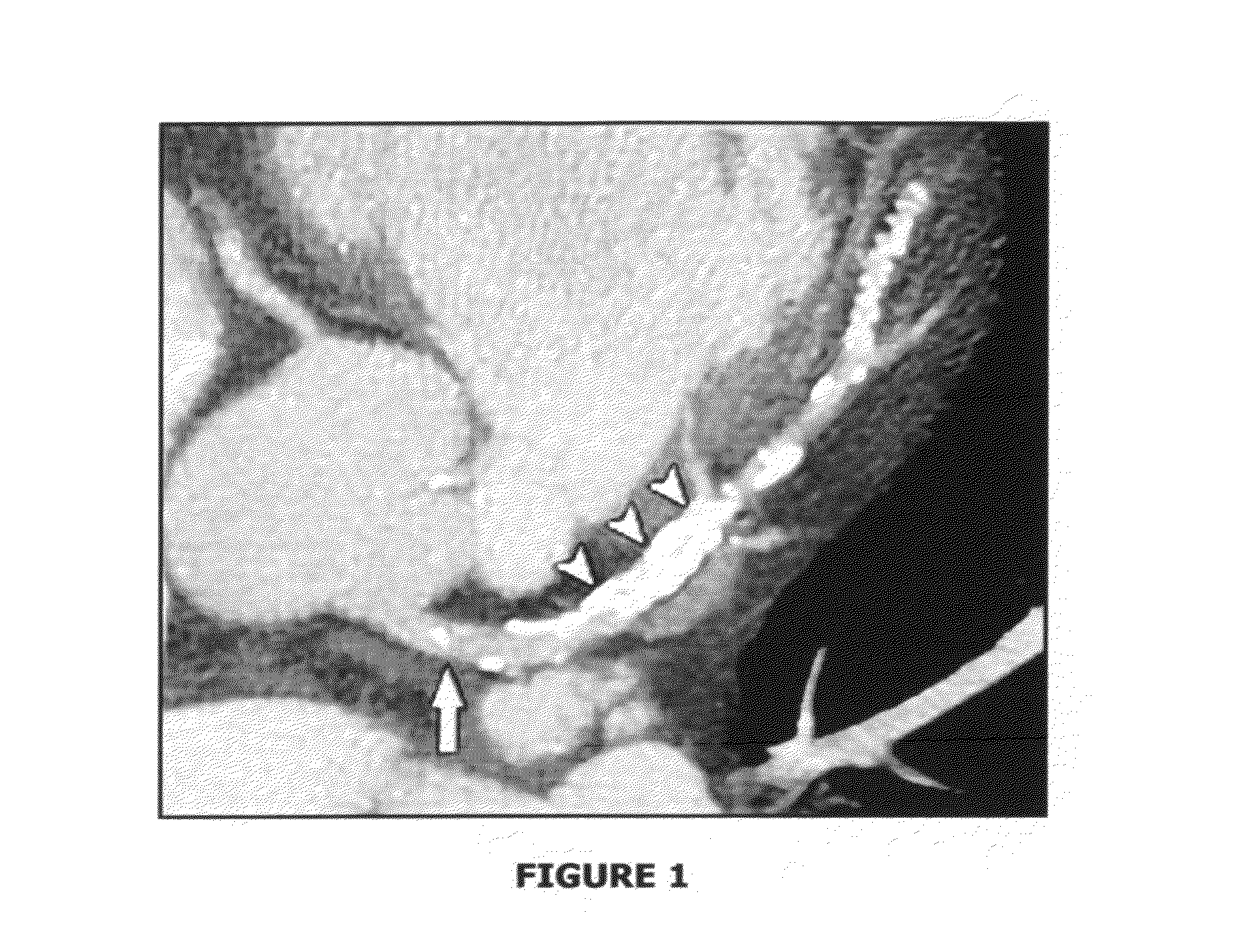 System for blood vessels cleaning, such as for a coronary artery, peripheral artery or any other body vessel, based on mobile agent