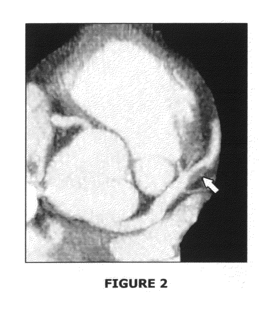 System for blood vessels cleaning, such as for a coronary artery, peripheral artery or any other body vessel, based on mobile agent