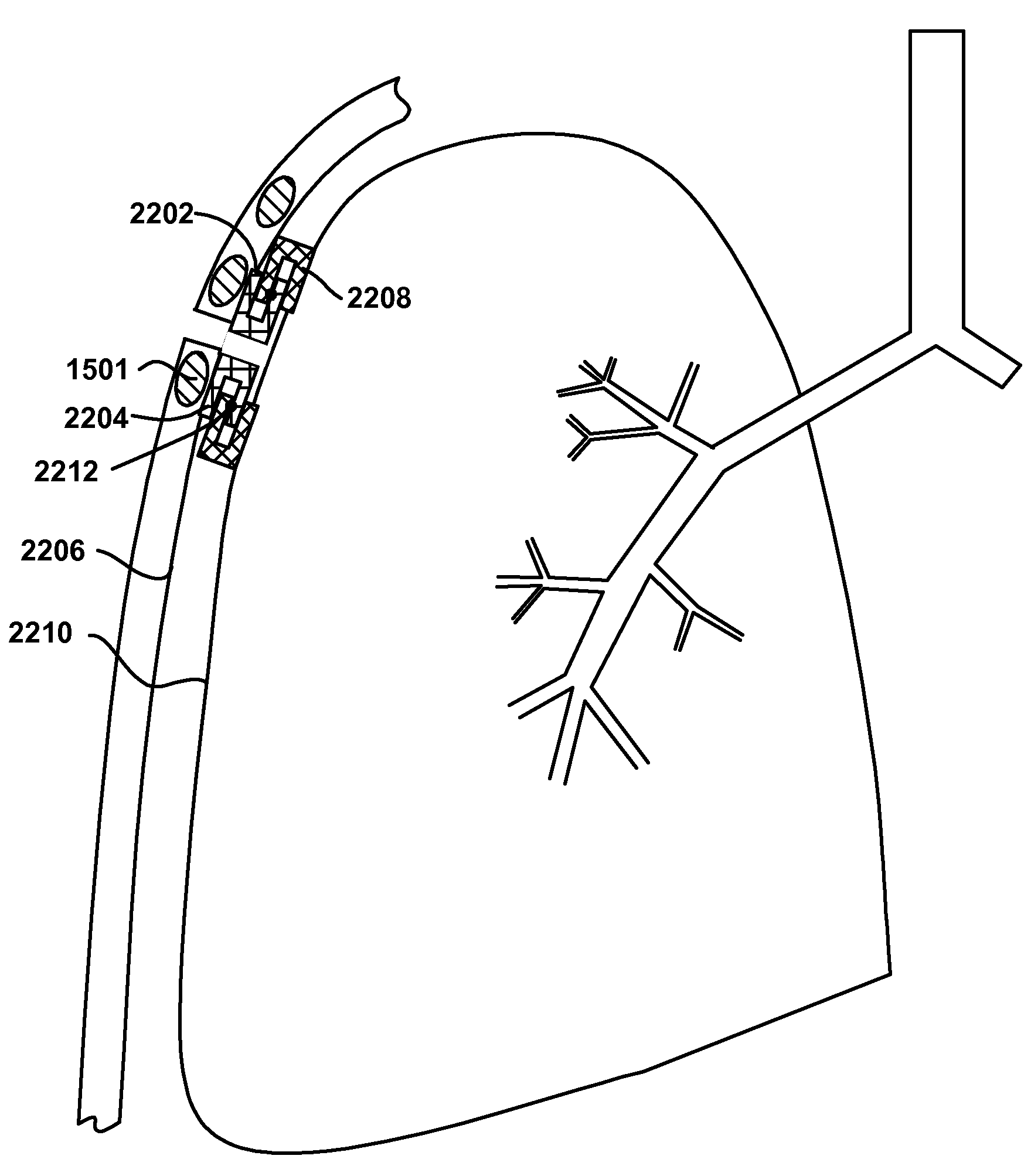 Variable parietal/visceral pleural coupling