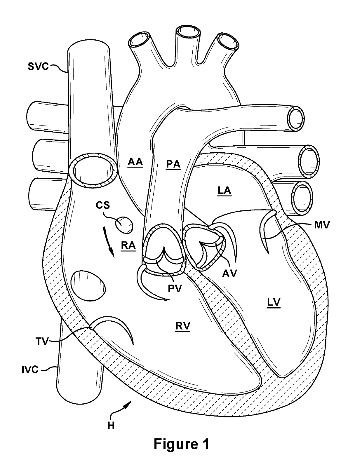 Native valve repair devices and procedures