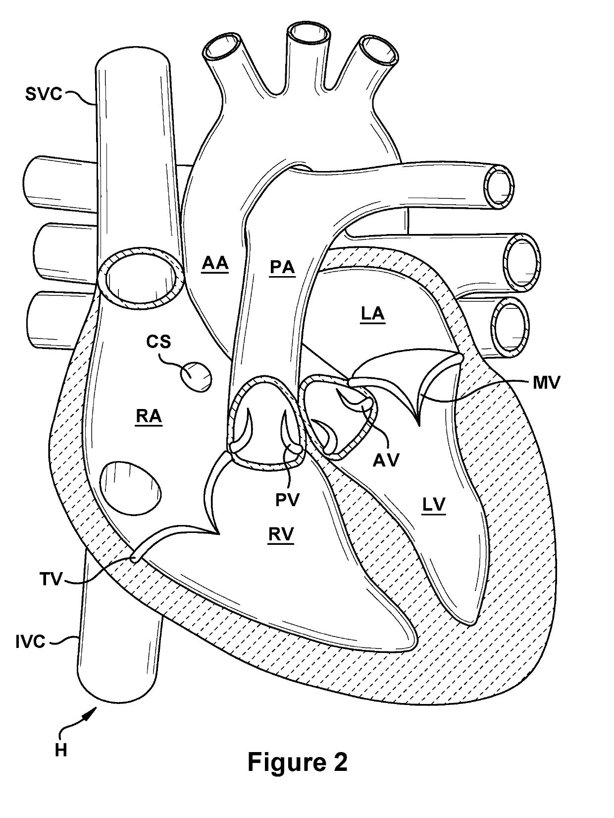 Native valve repair devices and procedures