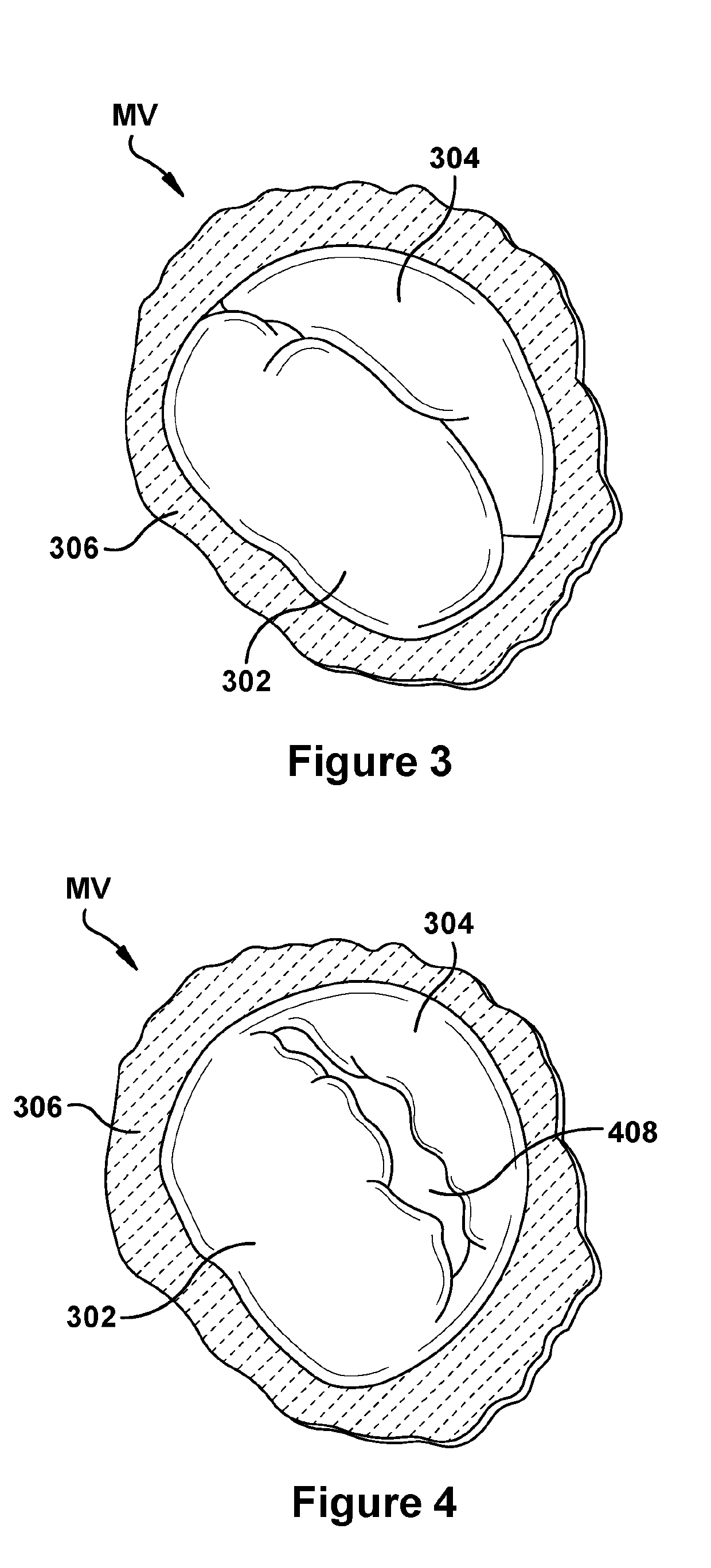 Native valve repair devices and procedures