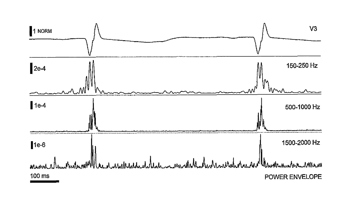 Method of EKG signal processing and apparatus for performing the method