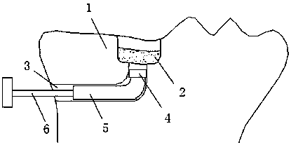 Minimally invasive repositor of tibial plateau collapse fracture block