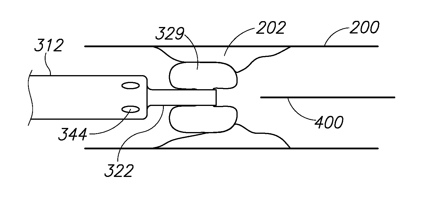 Variable length catheter for drug delivery