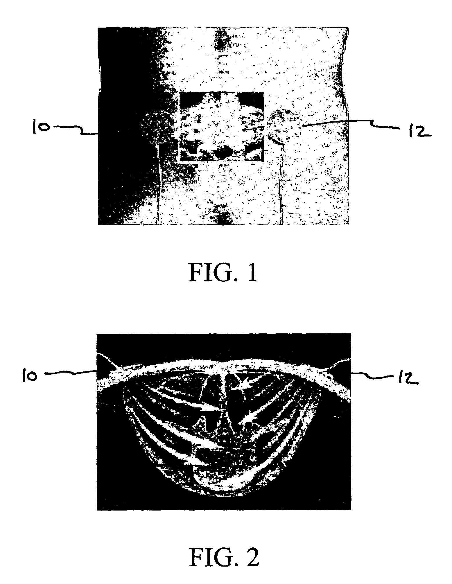 Method for treating degenerative disc disease using noninvasive capacitively coupled electrical stimulation device