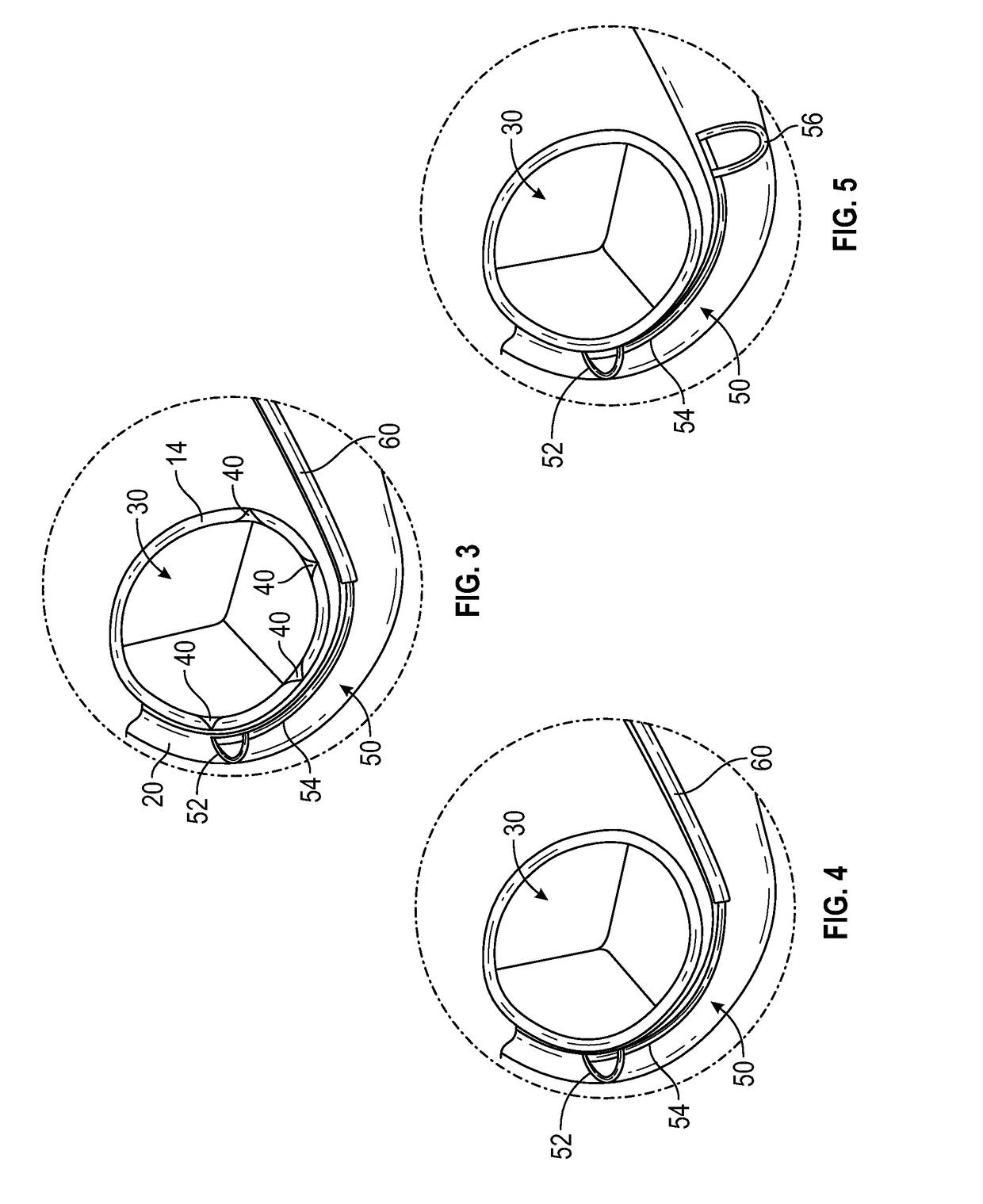 Methods and devices for reducing paravalvular leakage