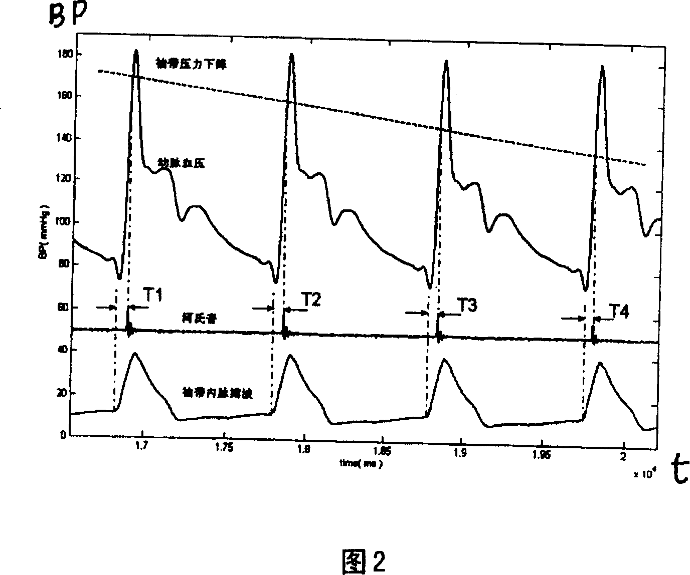 Detection method with blood pressure monitor and korotkoff sound delaying and pulse wave conducting time signal generator